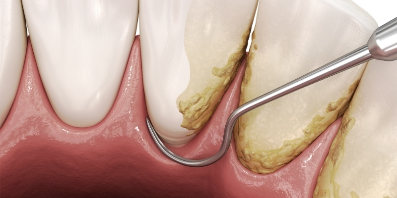 CURETAGE-DENTAL-EN-SEVILLA