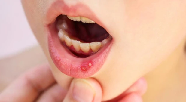 Estomatitis-aftosa-recurrente