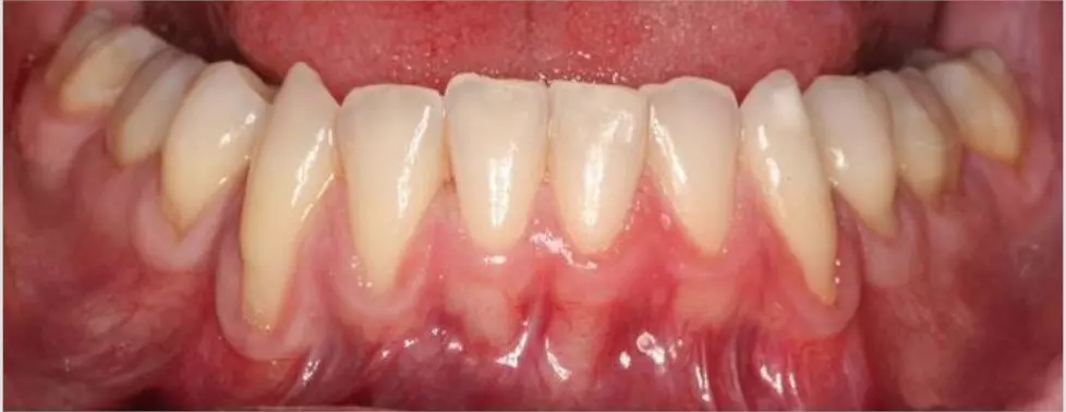 antes-periodoncia
