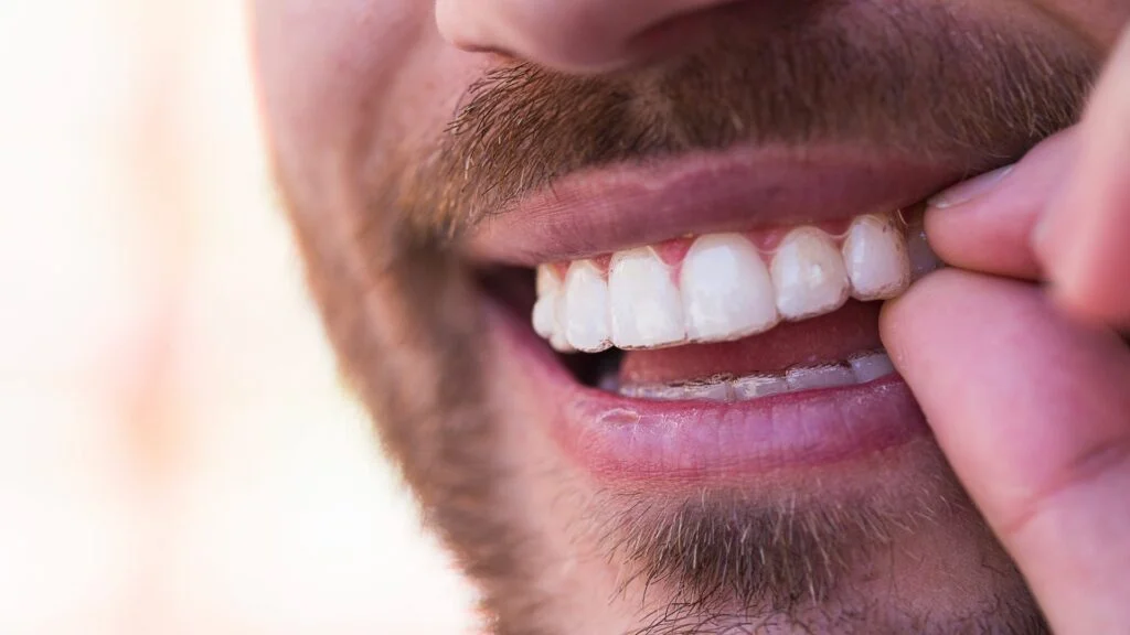 beneficios resultados invisalign