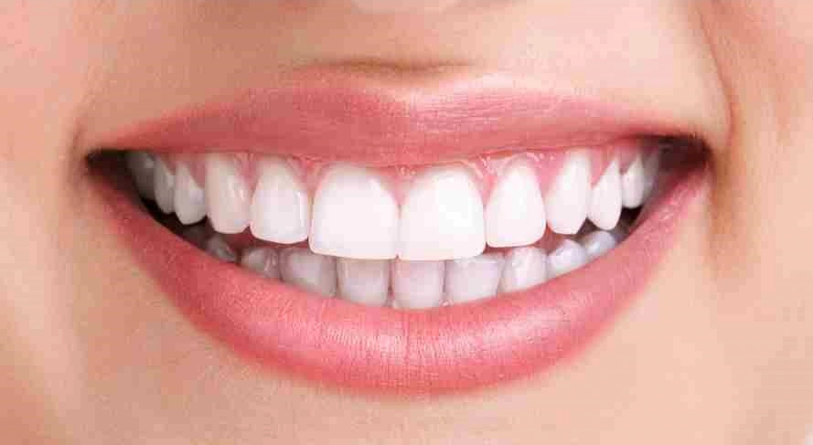 blanqueamiento-dental-despues