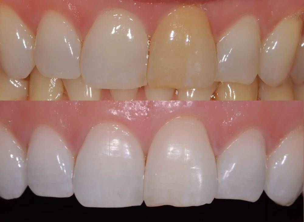 blanqueamiento dental interno