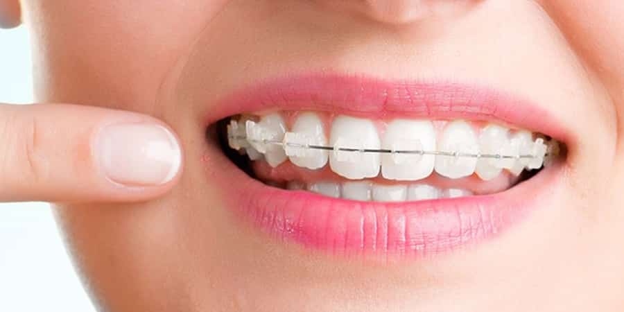 brackets-de-ceramica