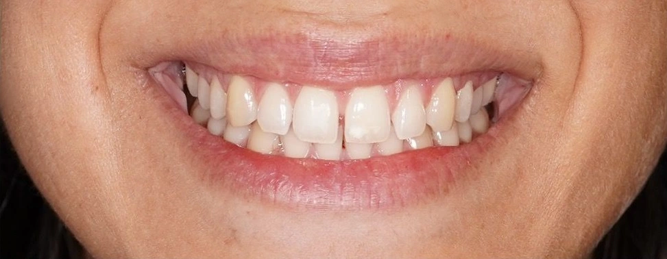 carillas-dentales-antes