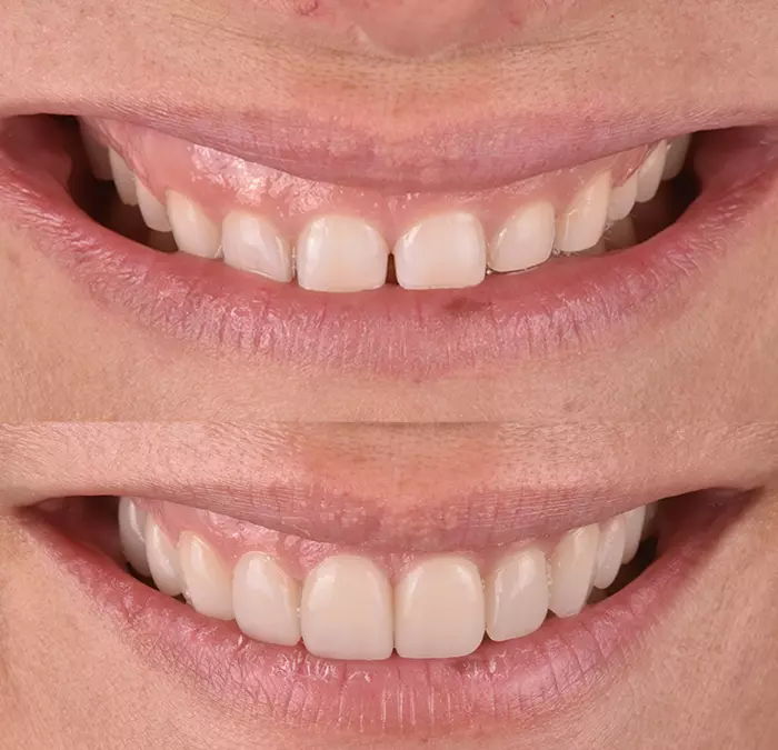 carillas-dentales-efecto-blanqueador