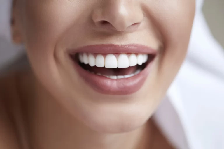 carillas-dentales-de-composite