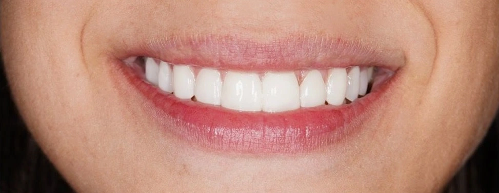 carillas-dentales-despues