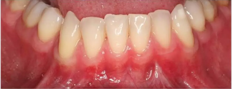 despues-periodoncia
