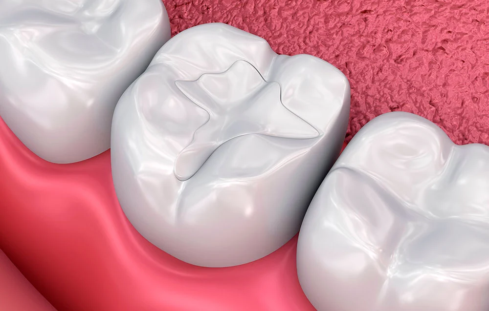 empastes-dentales-sevilla