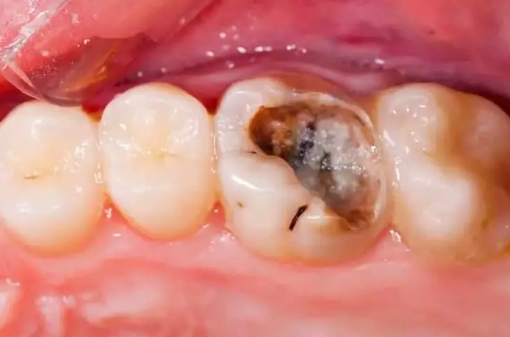 endodoncia-antes