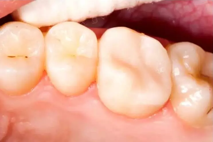 endodoncia-despues