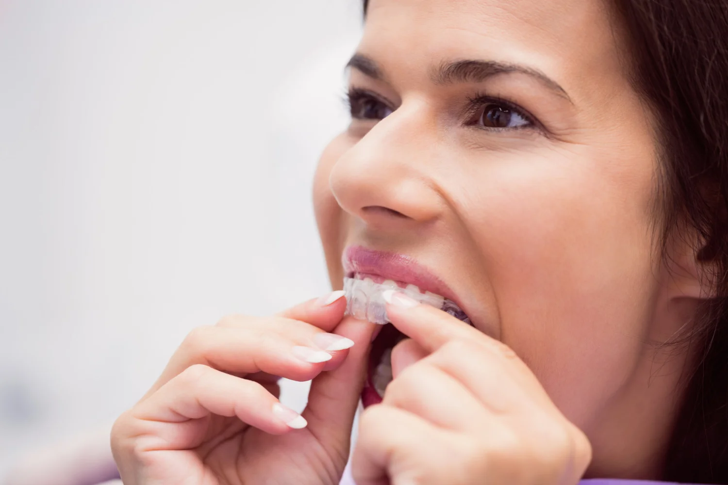 imagen portada retenedores dentales