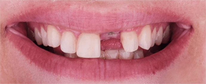 implantes-dentales-antes