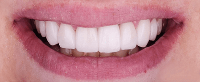 implantes-dentales-despues