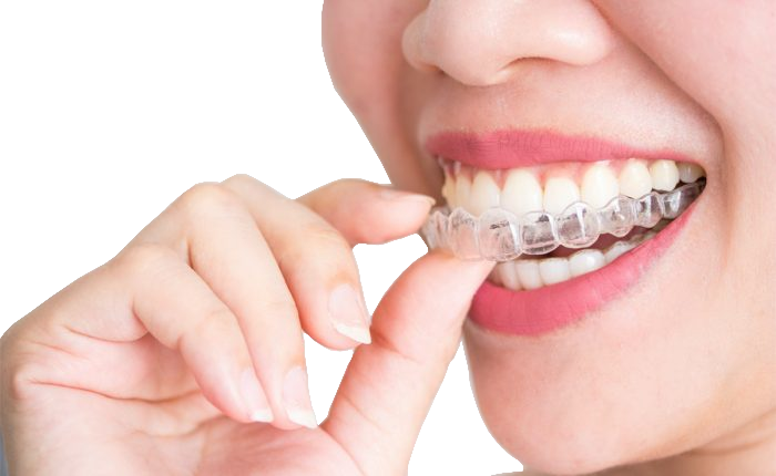 invisalign-sevilla