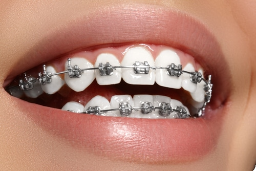 ortodoncia-brackets-sevilla