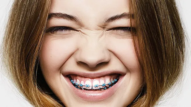 ortodoncias_brackets