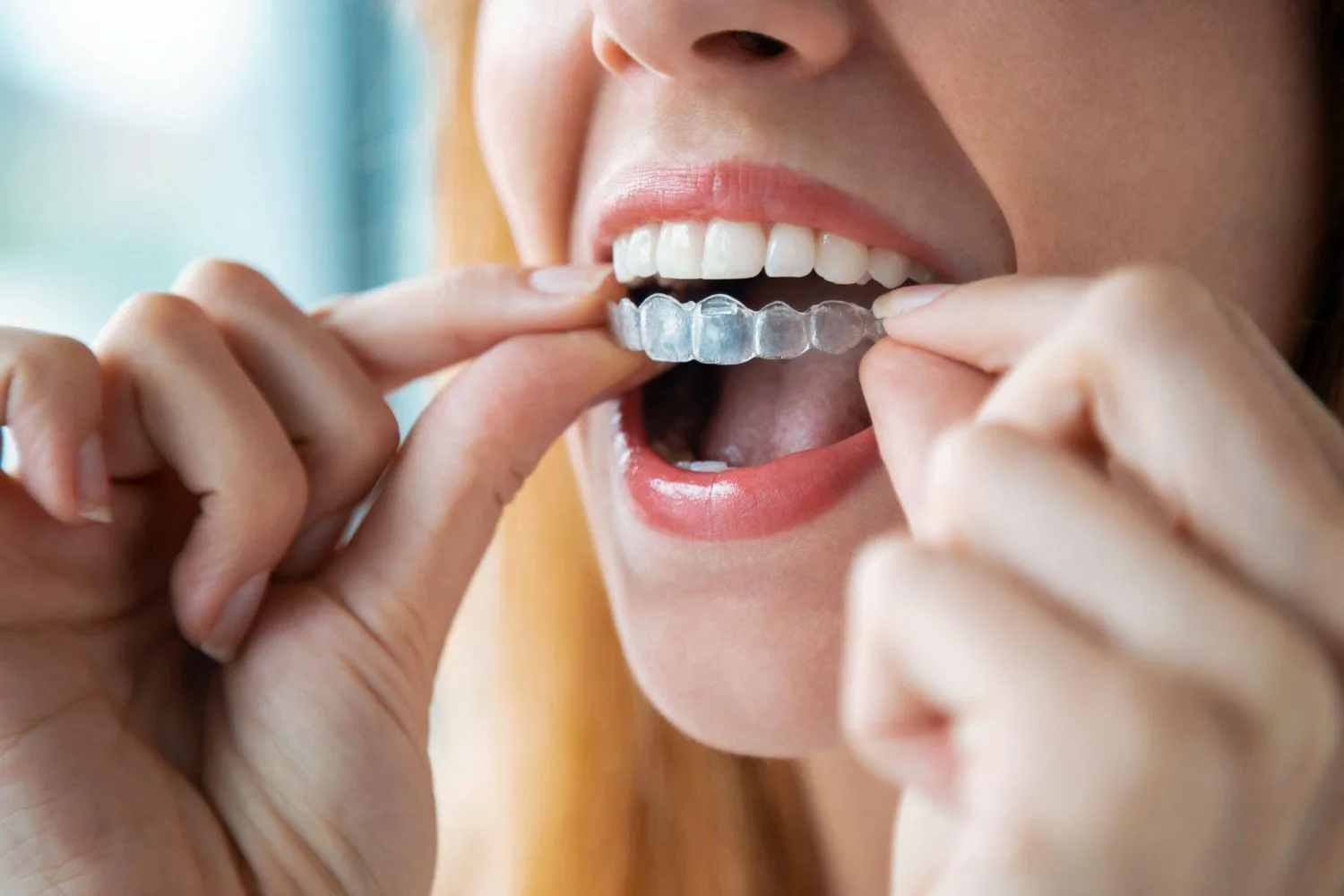 portada-cuando-se-ven-los-resultados-invisalign
