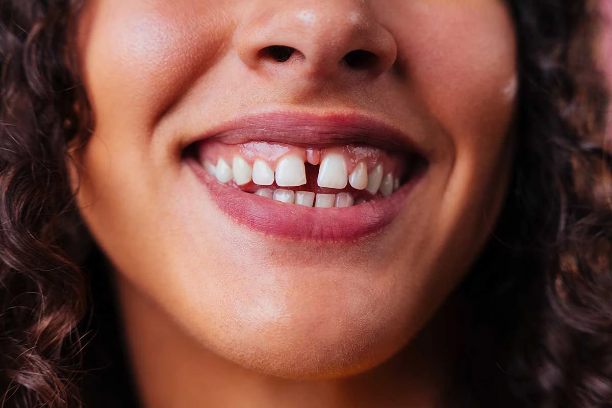 portada diastema