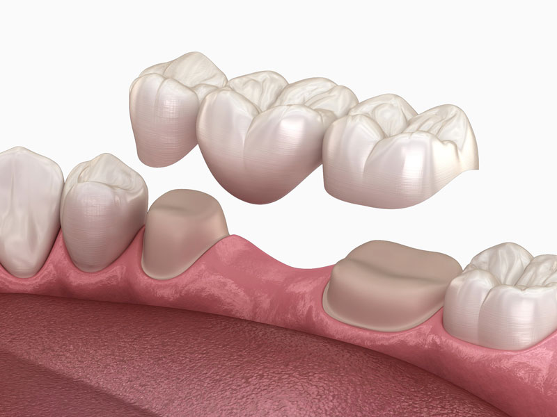 puente-dental-fijo