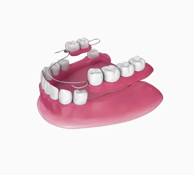 puente-dental-removible (1)