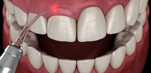 que es la gingivectomia