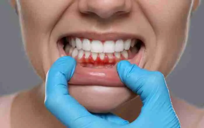 sangrado_dental