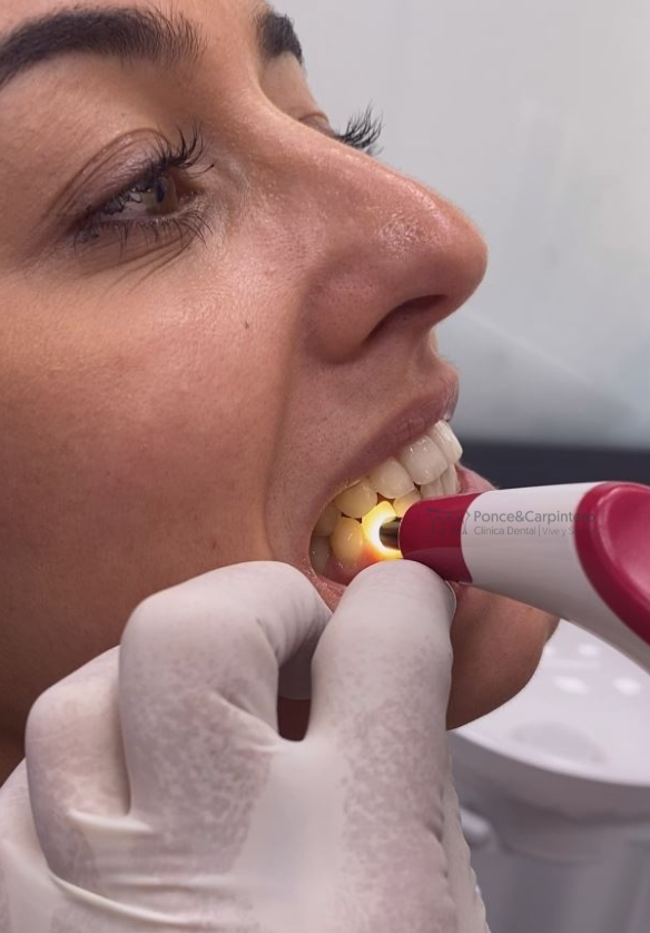 toma-color-blanqueamiento-dental